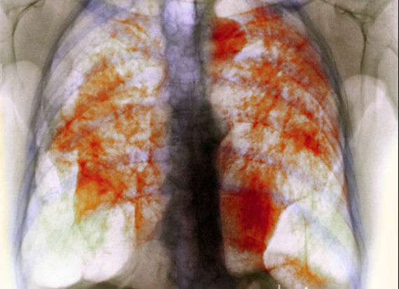 silicosis-6.jpg