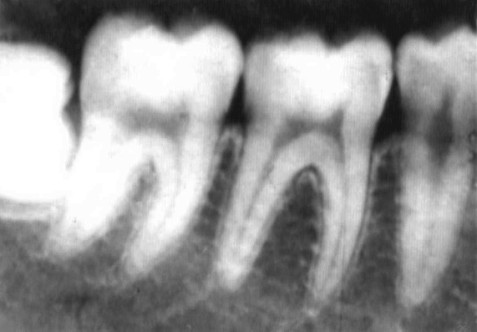 periapical.jpg