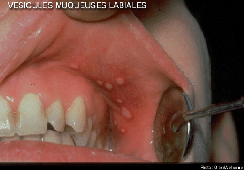 herpes-labial-2.jpg