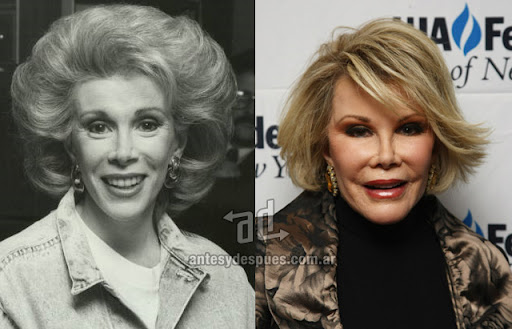 joan_rivers_antes_y_despues_cirugia.jpg