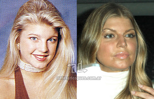 fergie_antes_y_despues_cirugia.jpg