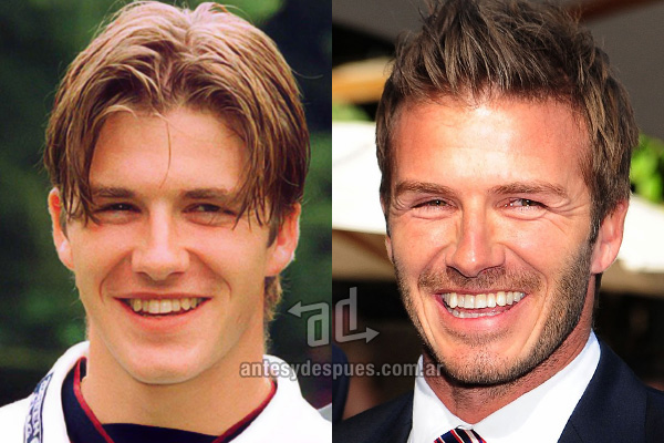 david-beckham_dientes_antesydespues.com.ar.jpg