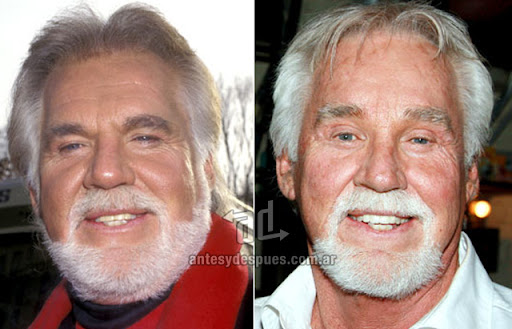 kenny_rogers_antes_y_despues_cirugia.jpg