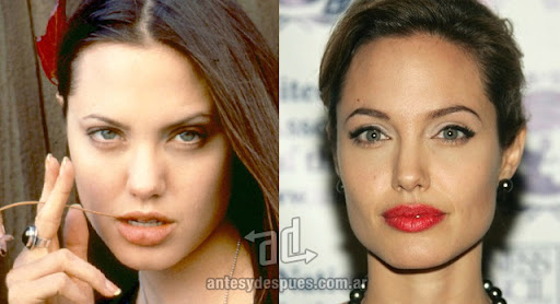 angelina_jolie_antes_y_despues_cirugia.jpg