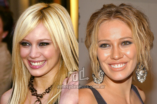hilary-duff_dientes_antesydespues.com.ar.jpg
