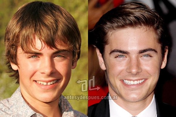 zac-efron_dientes_antesydespues.com.ar.jpg