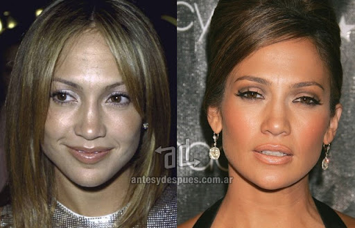 jennifer_lopez_antes_y_despues_cirugia.jpg