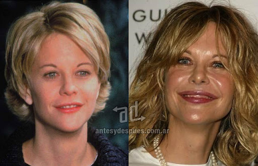meg_ryan_antes_y_despues_cirugia.jpg