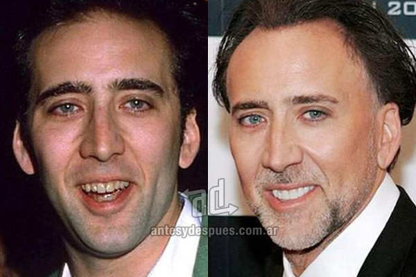 nicholas-cage_dientes_antesydespues.com.ar.jpg