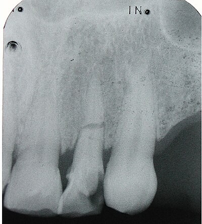 400px-Periapicalcasopr.jpg