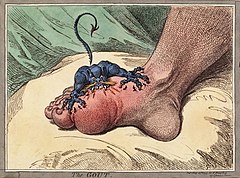 240px-The_gout_james_gillray.jpg