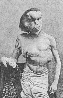 220px-Josephmerrick1889.jpg