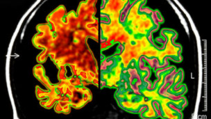 120329151223_alzheimer_304x171_spl_nocredit.jpg